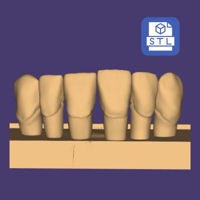 Archivo STL de carillas 3D imprimible